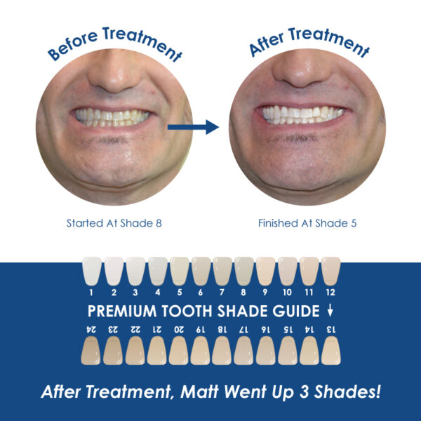 Medidenta - Whiter Image - 9% HP - Prefilled Teeth Whitening Tray - 07
